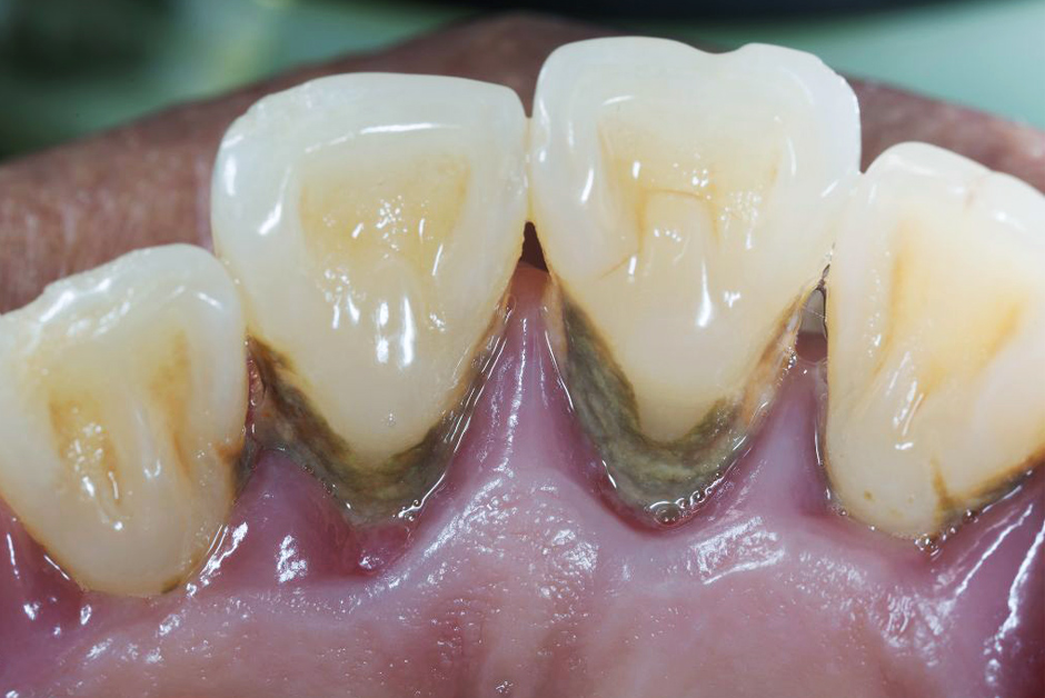 Periodoncia en N&S
